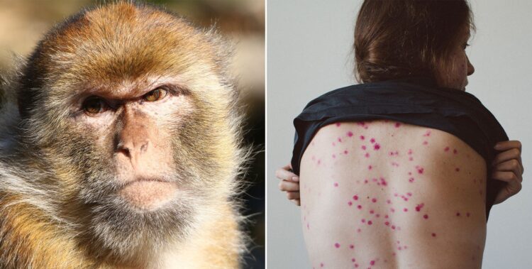 PRIMER CASO DE LA VIRUELA DEL MONO EN CORRIENTES